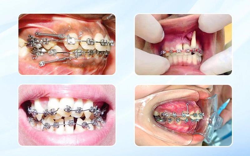 Niềng răng hỏng: Nguy cơ tiềm ẩn đằng sau lựa chọn “giá rẻ”