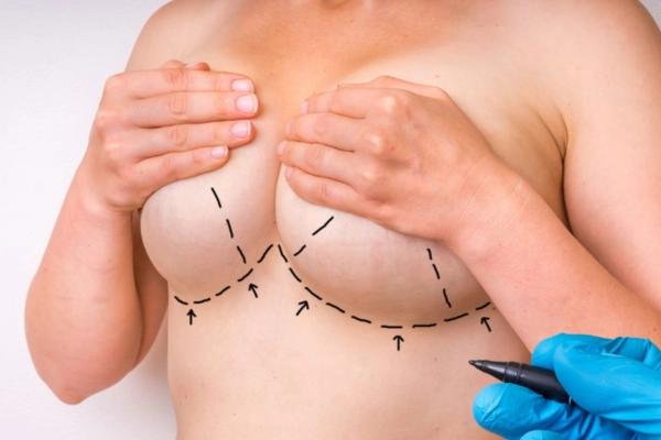 Nâng ngực đường nách, đường quầng vú, đường chân ngực: Nên chọn đường mổ nào?