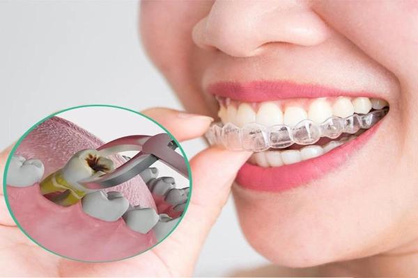 Giải đáp: Niềng răng có cần nhổ răng không?