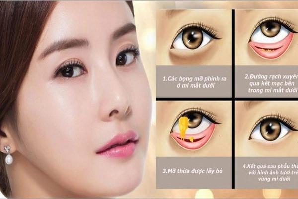 Phẫu thuật bọng mắt - Giải pháp lấy lại vẻ tươi trẻ cho đôi mắt