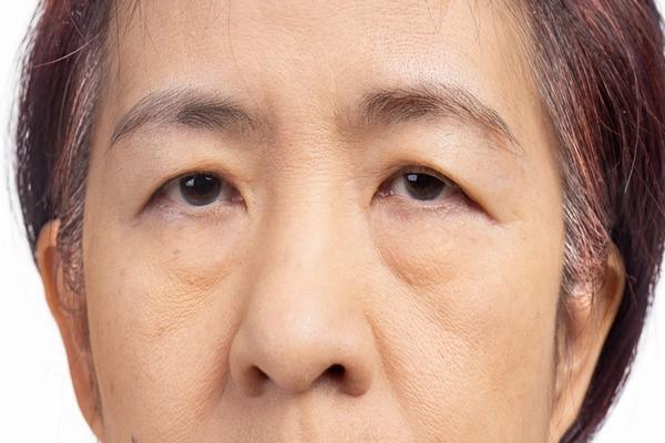 Sụp mí mắt là gì? Nguyên nhân, triệu chứng và cách điều trị