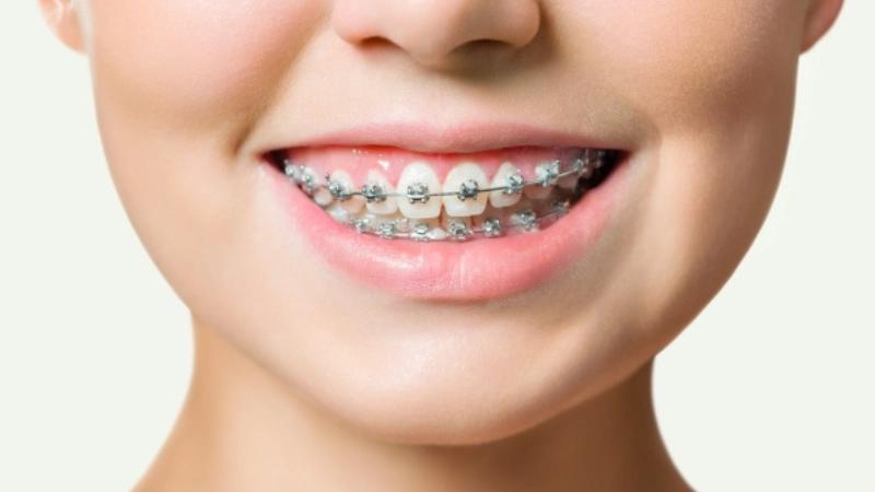Những điều cần biết trước khi niềng răng mắc cài