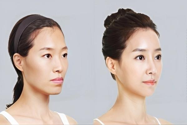 Tiêm filler má hóp: Cải thiện độ đầy đặn cho khuôn mặt 